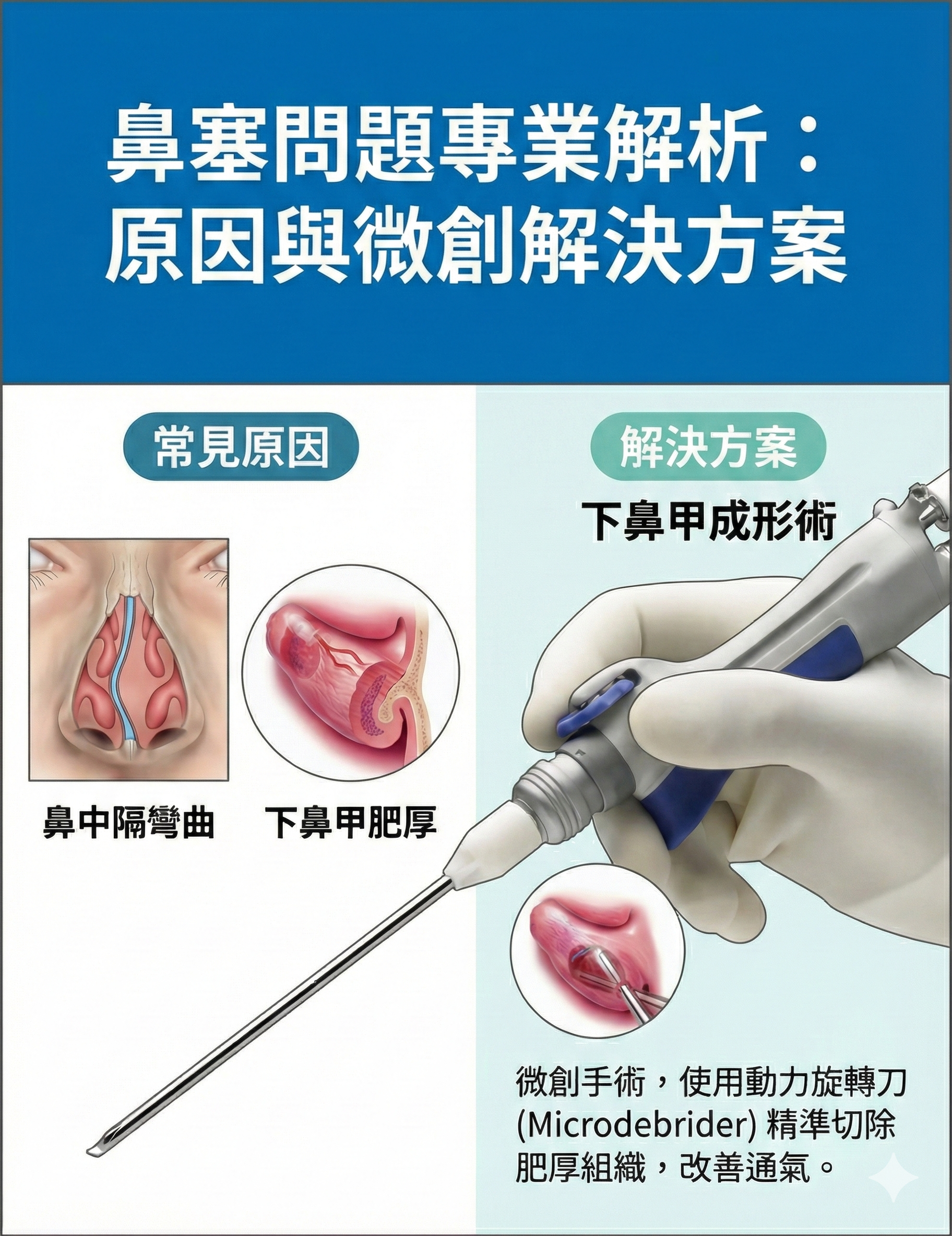 動力旋轉刀下鼻甲成形術微創手術示意圖